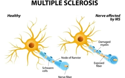 What is Multiple Sclerosis – causes and symptoms