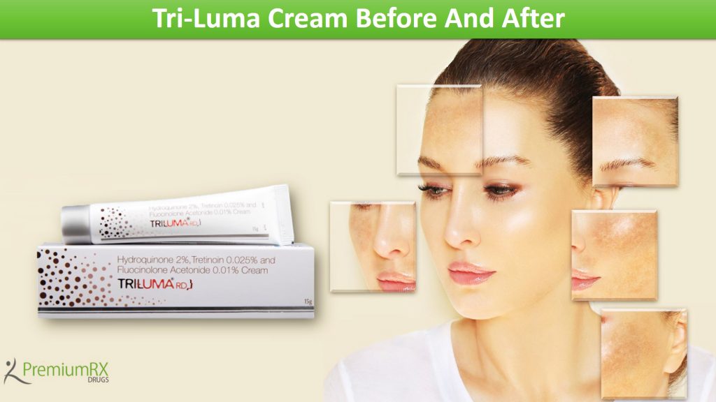 Tri Luma Cream Before And After Premiumrx Online Pharmacy